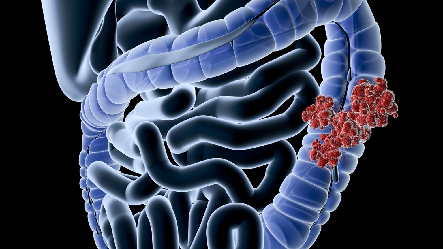 Researchers Make Breakthrough In Resistance To Colon Cancer Treatment